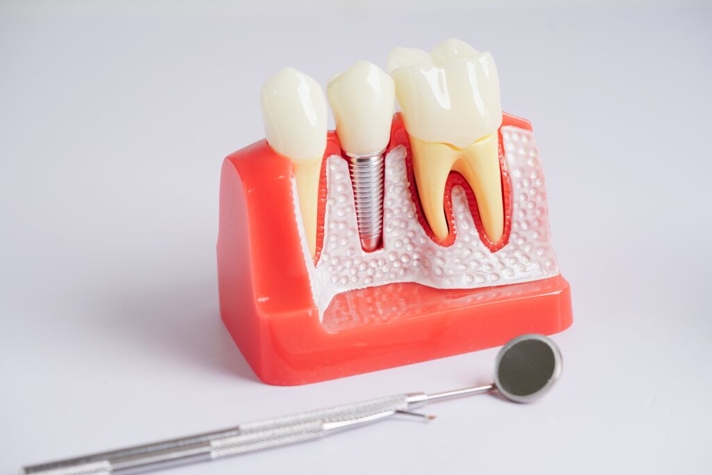 dental implants honolulu hi