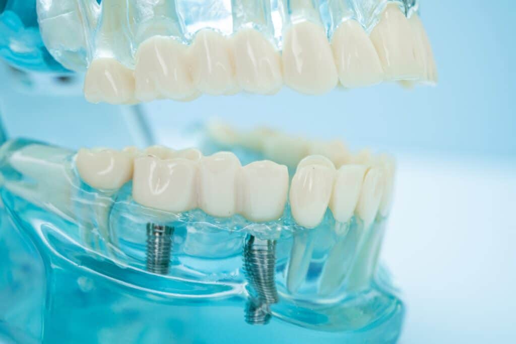 dental implants near me