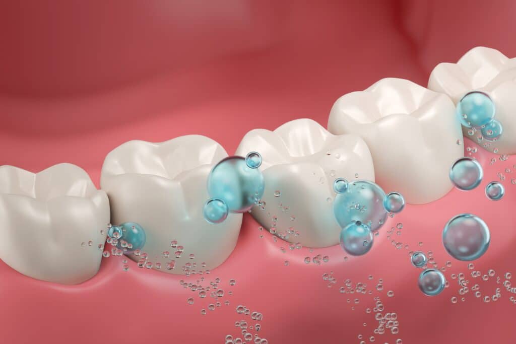 fluoride treatment honolulu